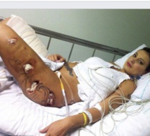 Elle a voulu gonfler ses fesses et ses jambes…Andressa entre la vie et la mort