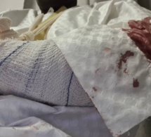 Après l’attaque du cortège d'Ousmane Sonko à Koungheul : Malick Gackou s’en sort avec une fracture ouverte de l'avant-bras gauche