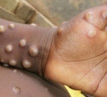 Mpox : L'OMS prolonge son niveau d'alerte maximale